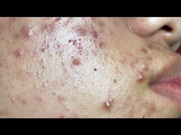 Make your Acne Treatment Huong Da Nang