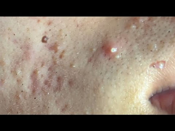 Make your Acne Treatment Huong Da Nang#501 | acne 2022