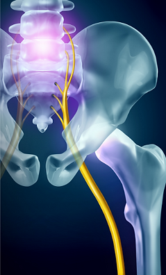 Sciatica pain physiotherapy near Kingswood – Genuine Physio