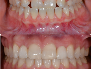 From Crossbite to Confident Smile: A Truly Life-Changing Transformation