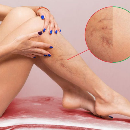 Flebite: entenda a doença, seus sintomas e formas de prevenção