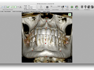 Validação do software aberto OsiriX para antropometria aplicada à Reconstrução Facial Forense