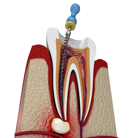 Pain-Free Root Canal Treatment: Dispelling Common Fears and Misconceptions