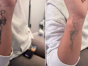 Laser Tattoo Removal