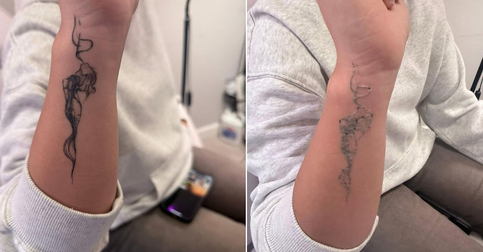 Laser Tattoo Removal