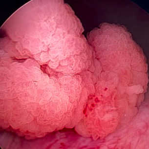 Tumor de Bexiga - epidemiologia, diagnóstico e tratamento