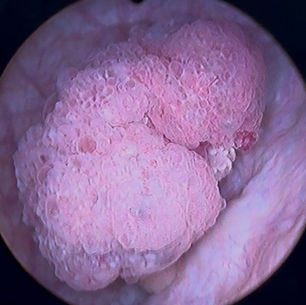 Tumor de bexiga