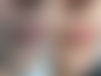 👀 5 Signs Your Filler Has Migrated—and What to Do About It