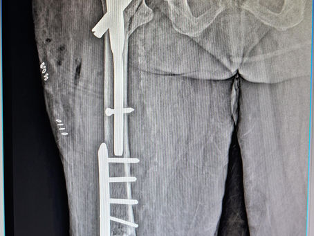 Advanced Joint Reconstruction Techniques Explained