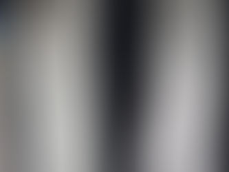 Fracture of distal radius-best management