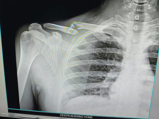 Clavicle fractures l, should be it be fixed or not??