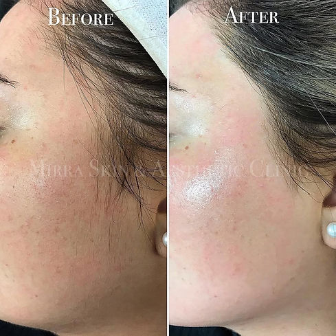 ⭐️Airbrushed skin instantly⭐️The perfect pre-event skin….Dermaplaning is a safe and non- i