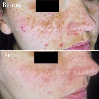 ✨ Treating Pigmentation & Congestion with Retinol Peels ✨Retinol, a powerful derivative of