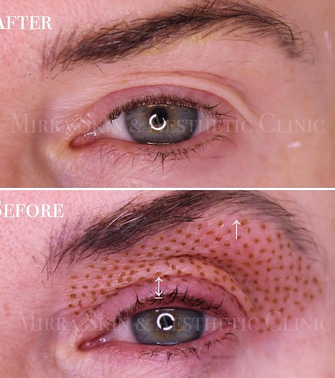 🪢 Plasma Skin Tightening! 🪢This client sought treatment for concerns including fine line