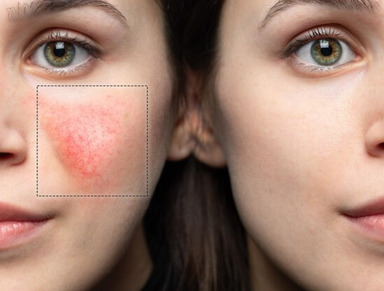 Rosacea-Management.png