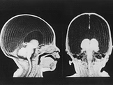 The Cerebral Cortex Does Not Generate the Human Mind