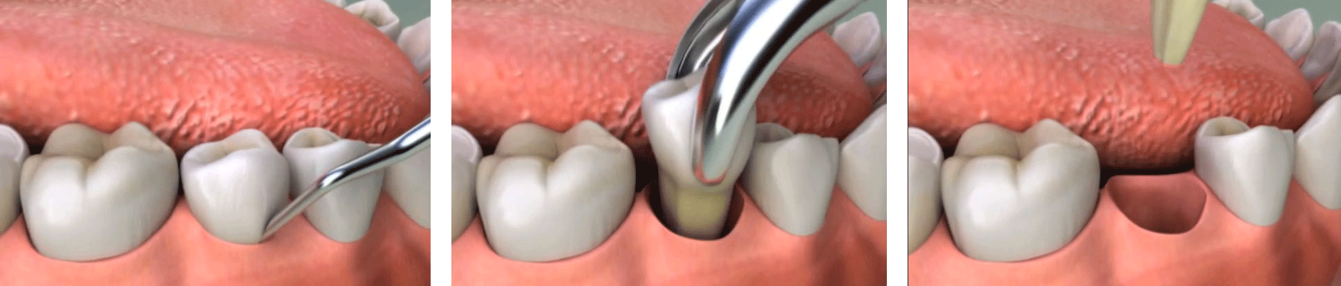 teeth-extraction-content.gif
