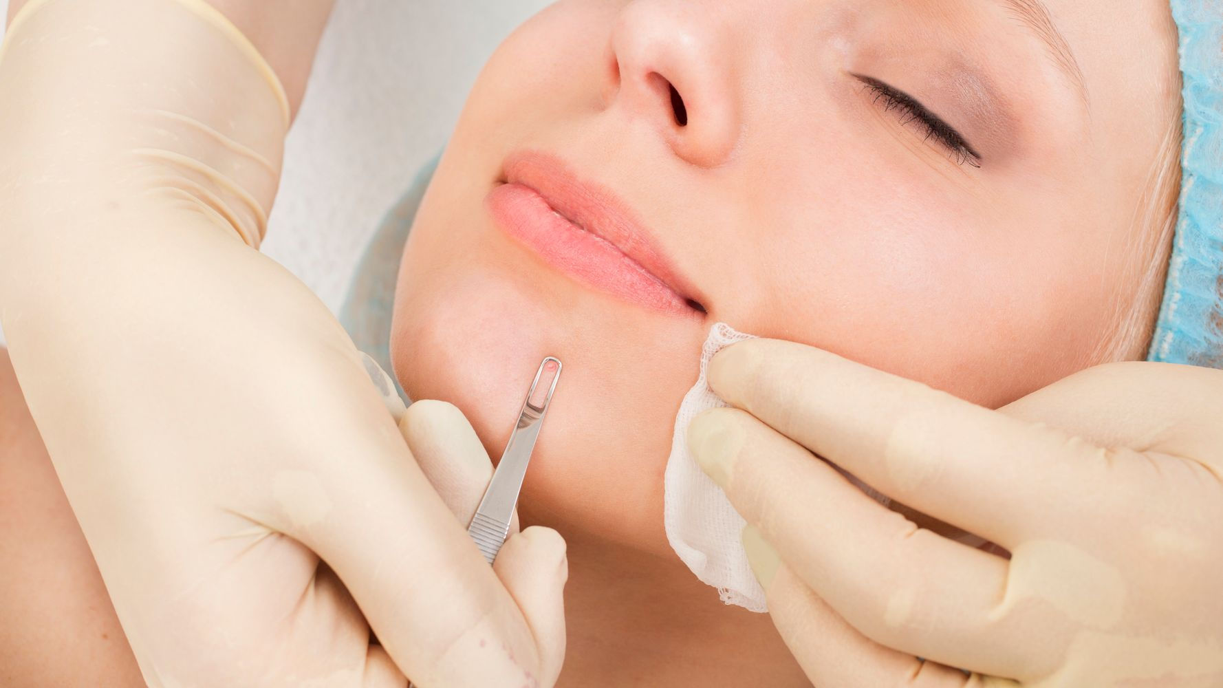 Blackhead Extractions