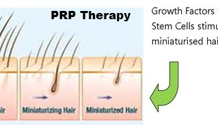 PRP Therapy for Hair Loss