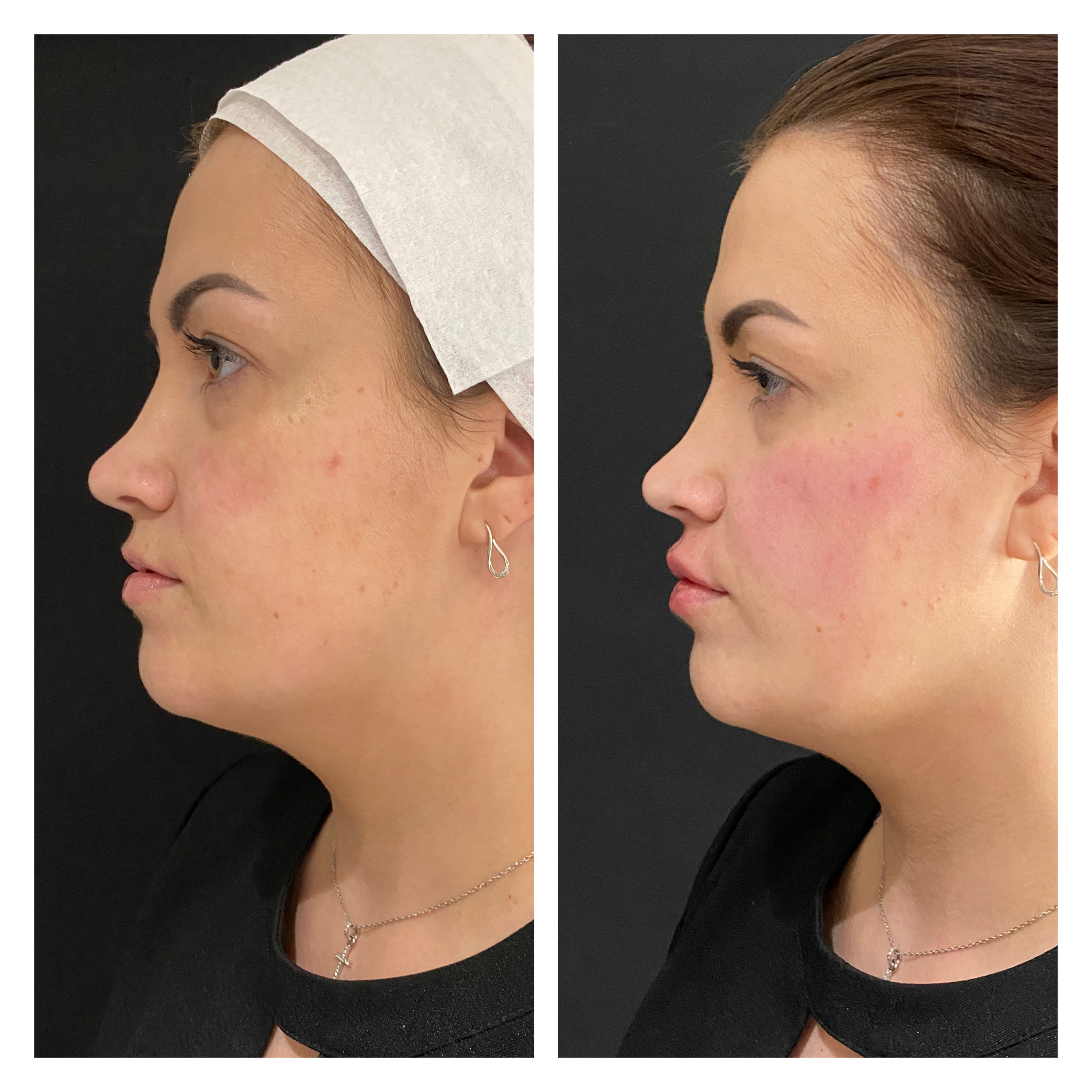 Cheek and lip filler