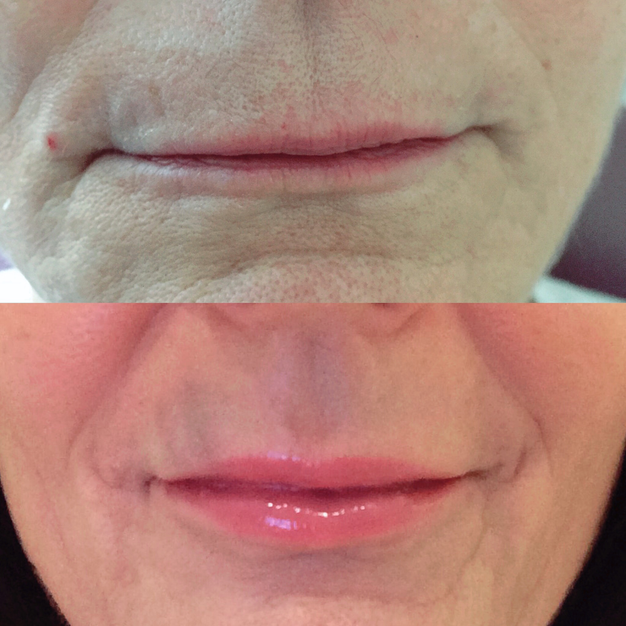 Lip enhancement