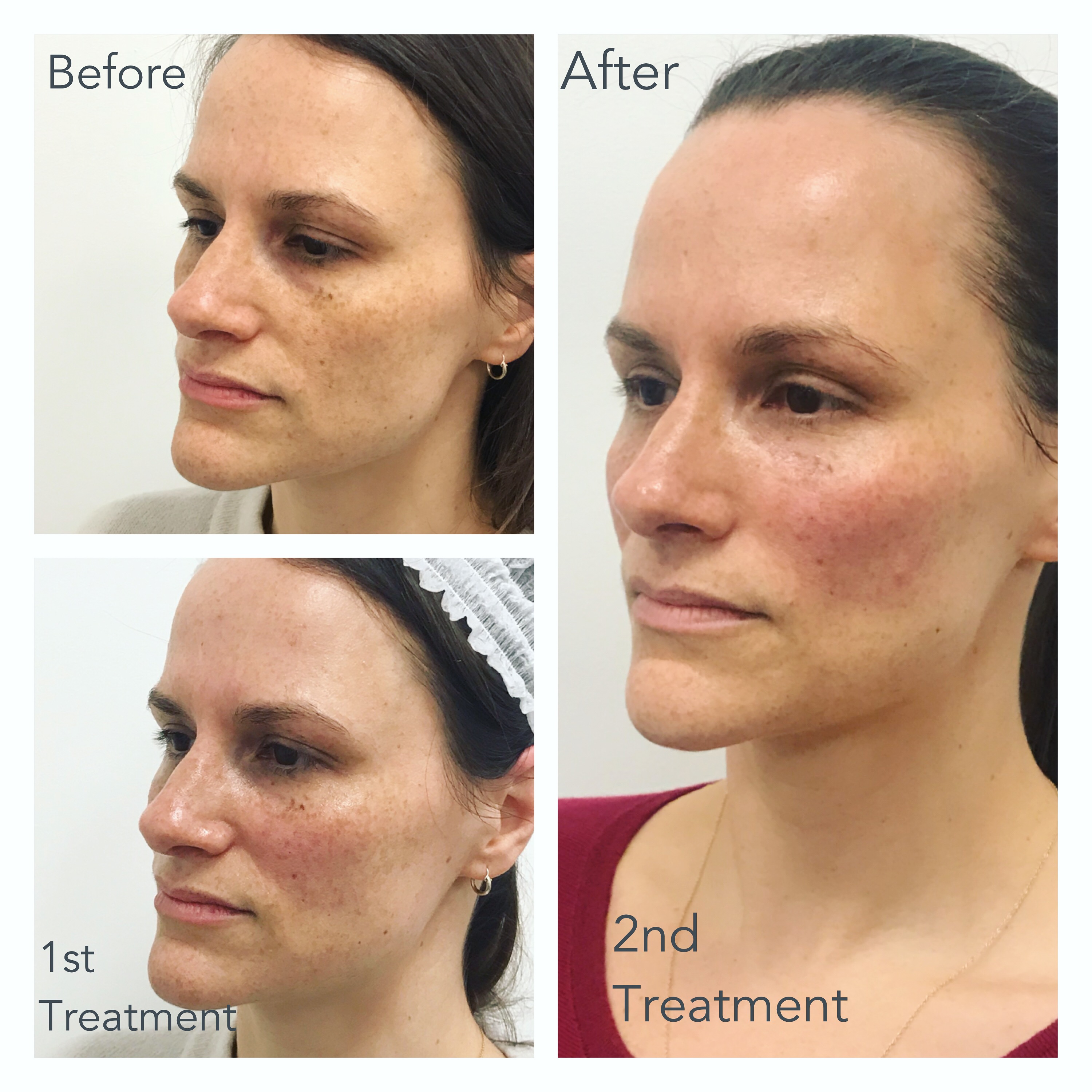 Mid- face Volumisaton