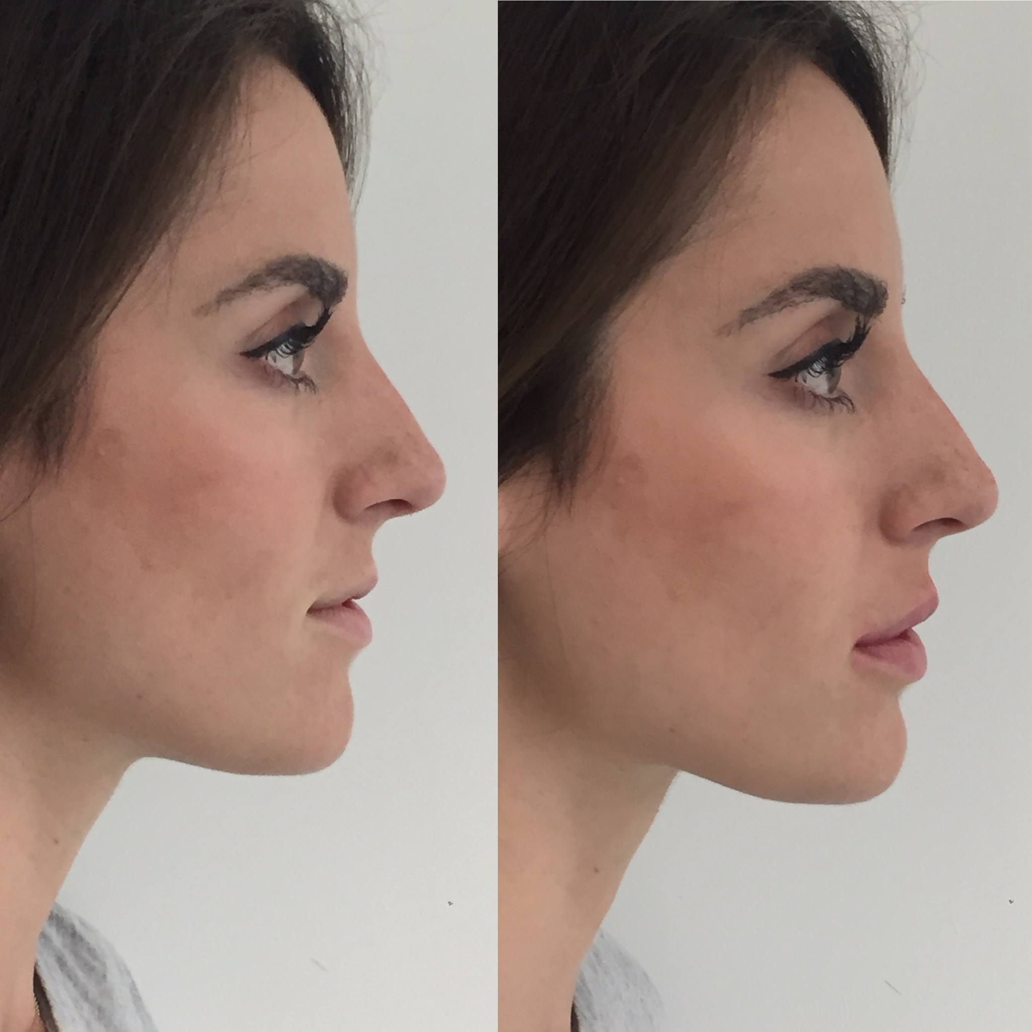 Lip enhancement 1ml