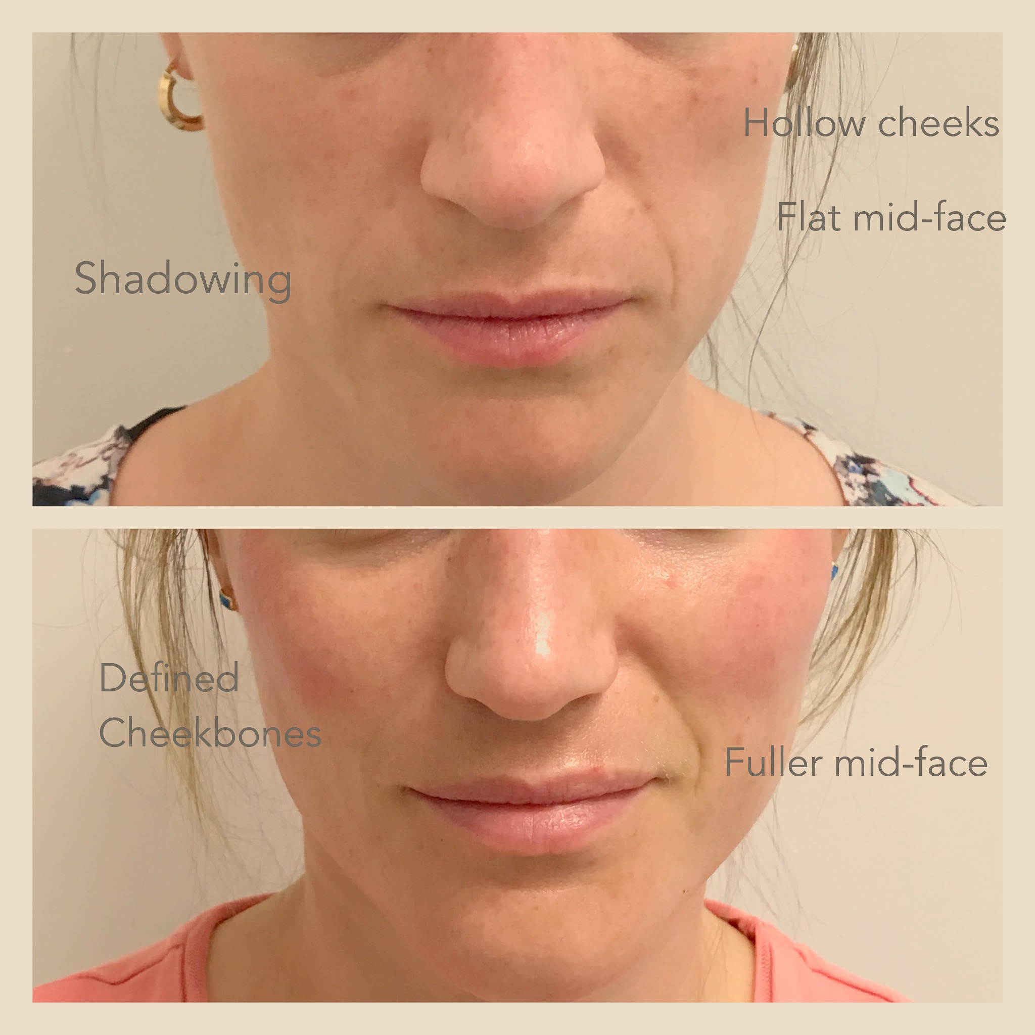 Cheek fillers