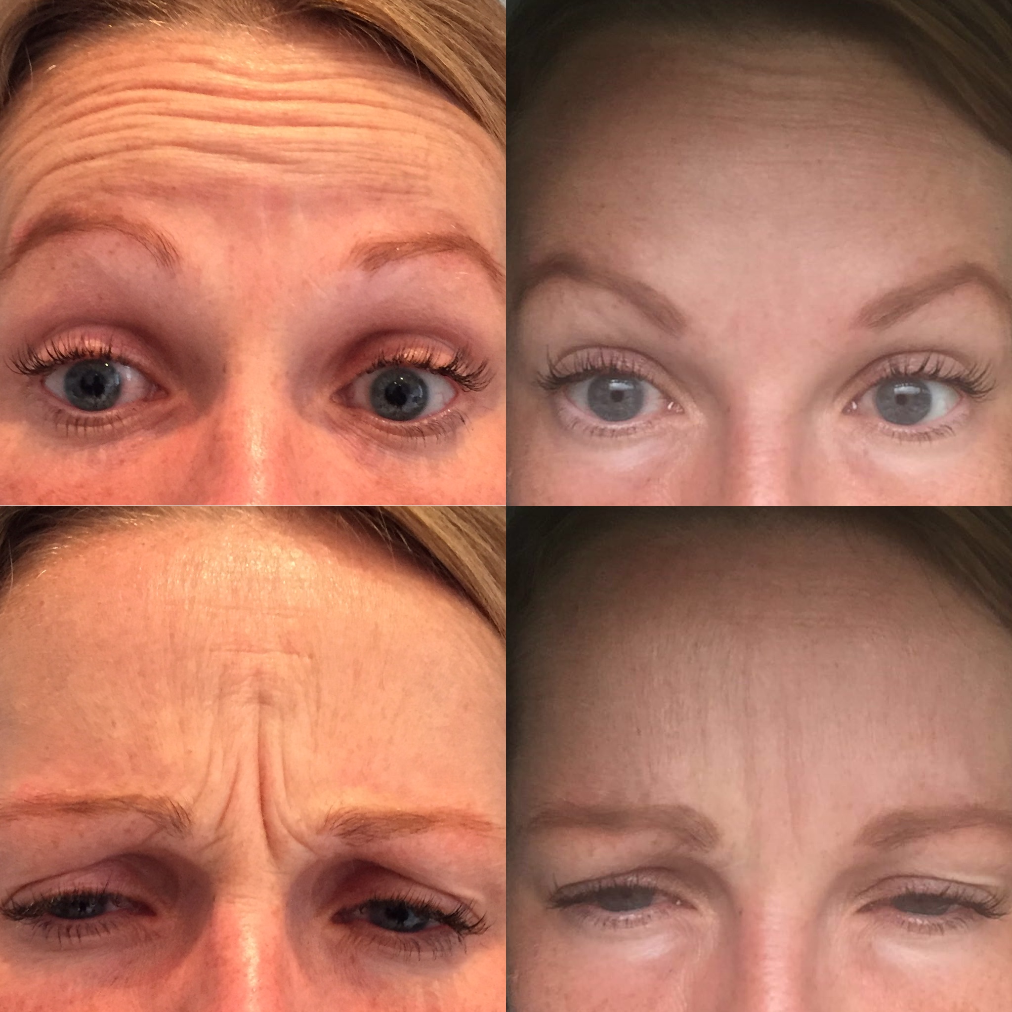 Forehead and Frown lines