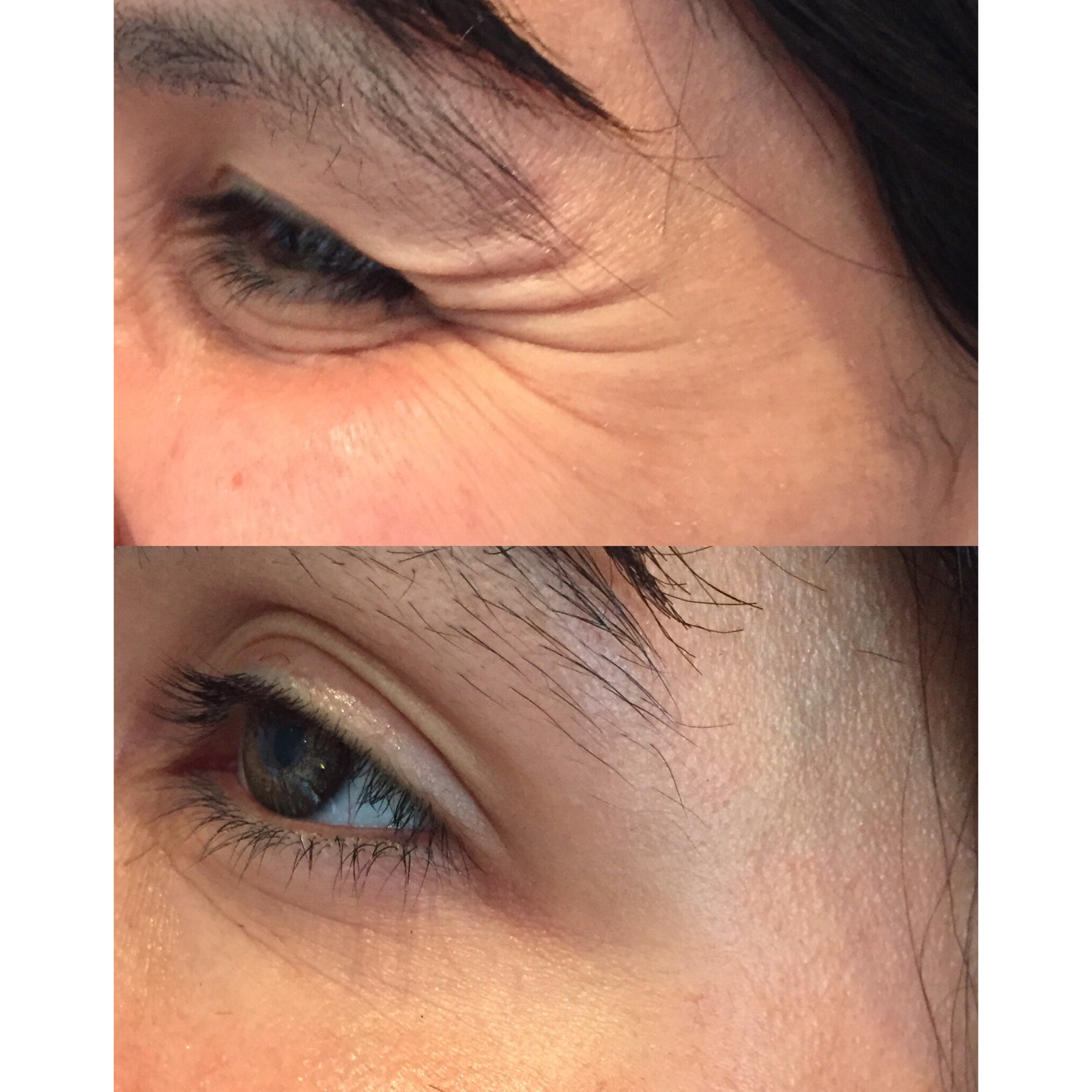 Crow's feet treatment with toxin