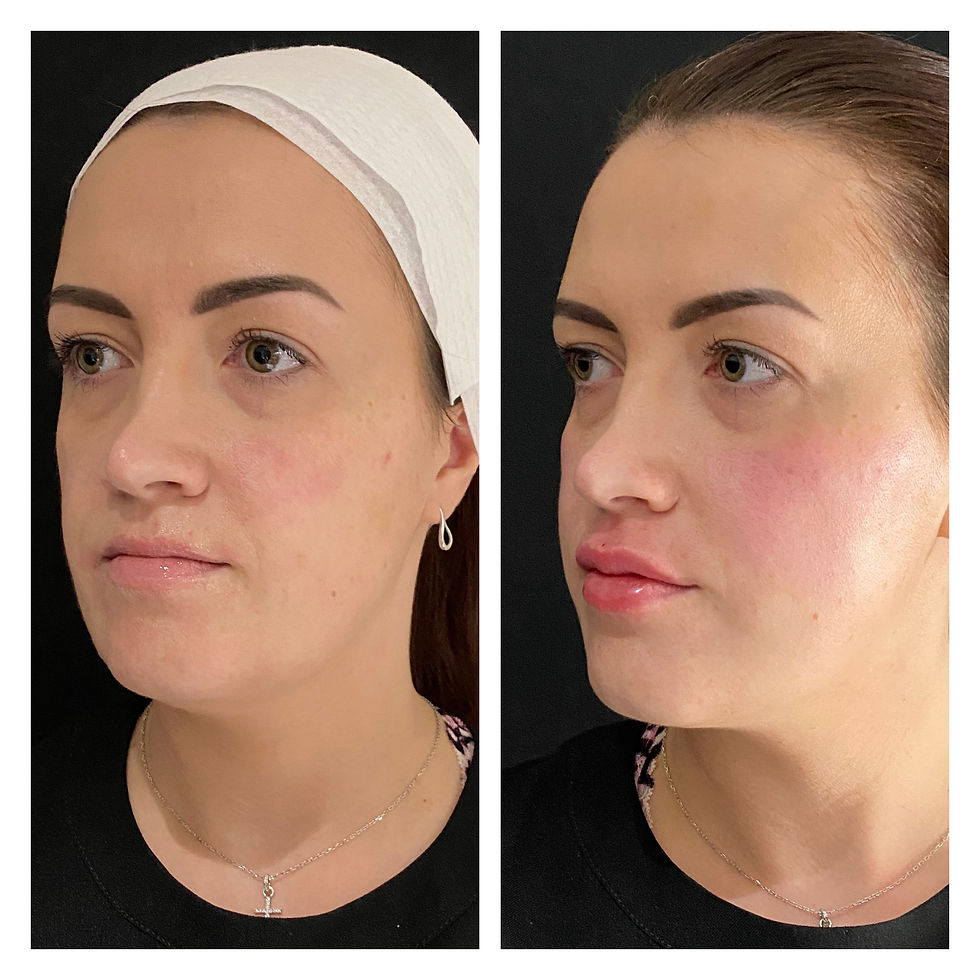 Vobella Lip enhancement
