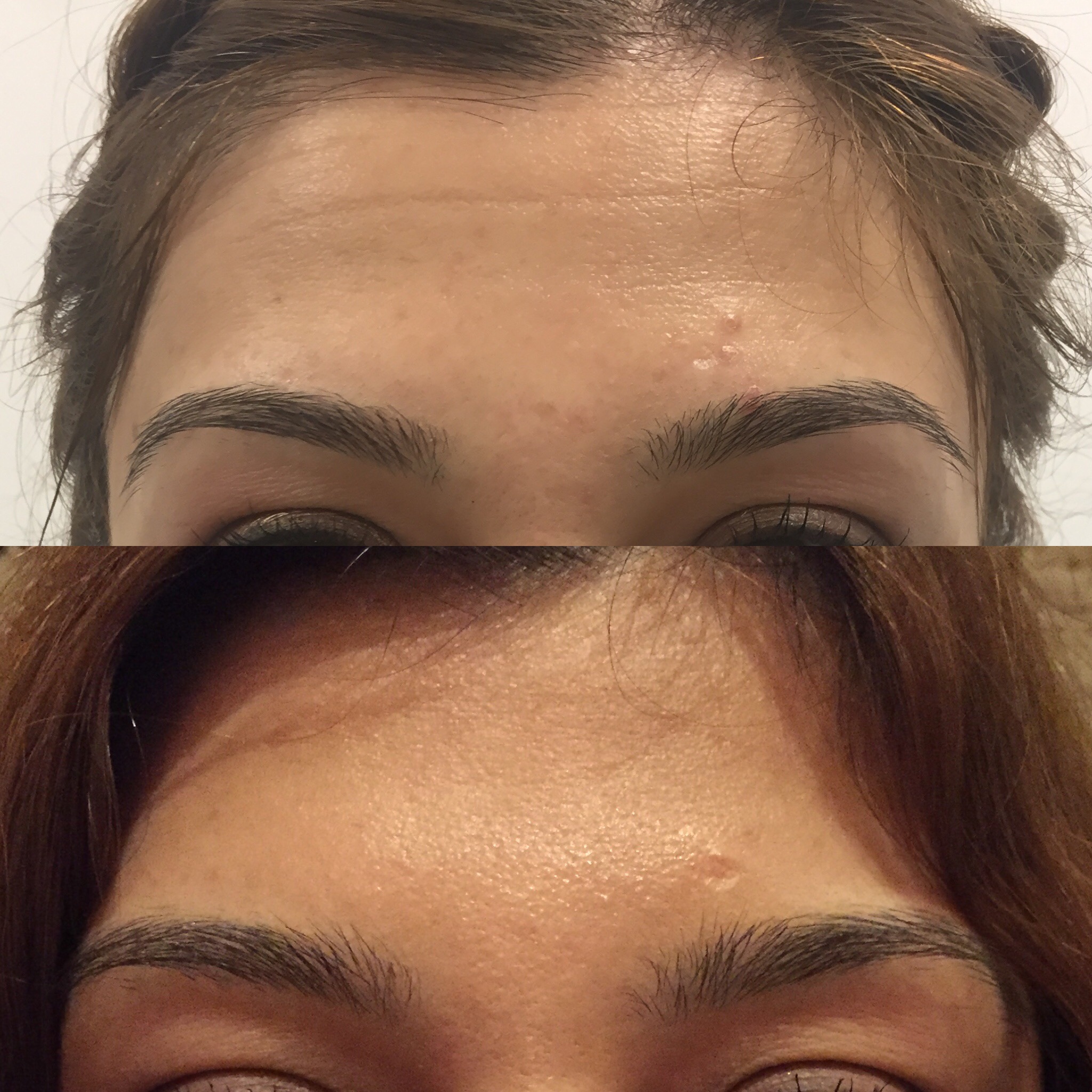 Preventative anti-wrinkle injections