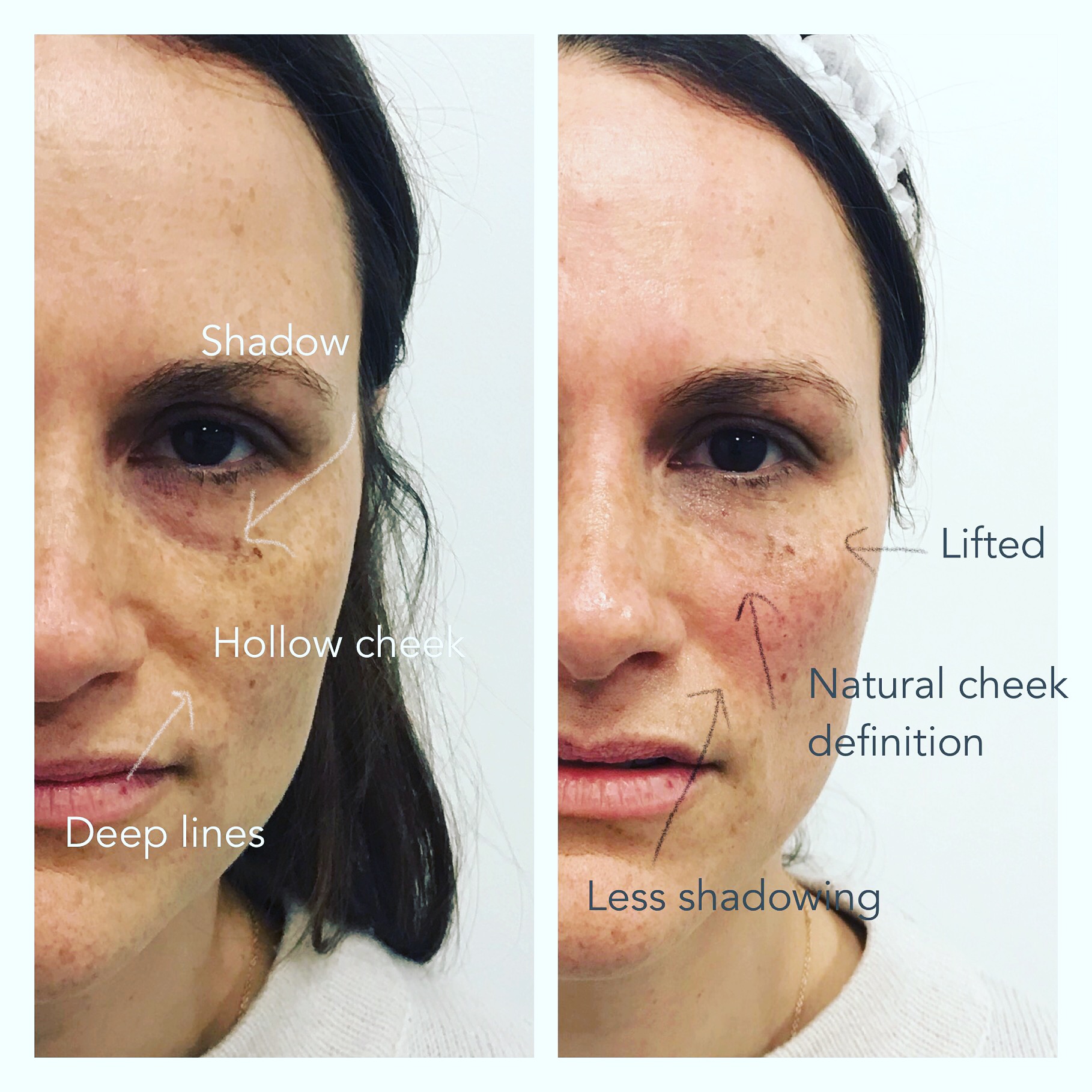 Correctly hollow cheeks