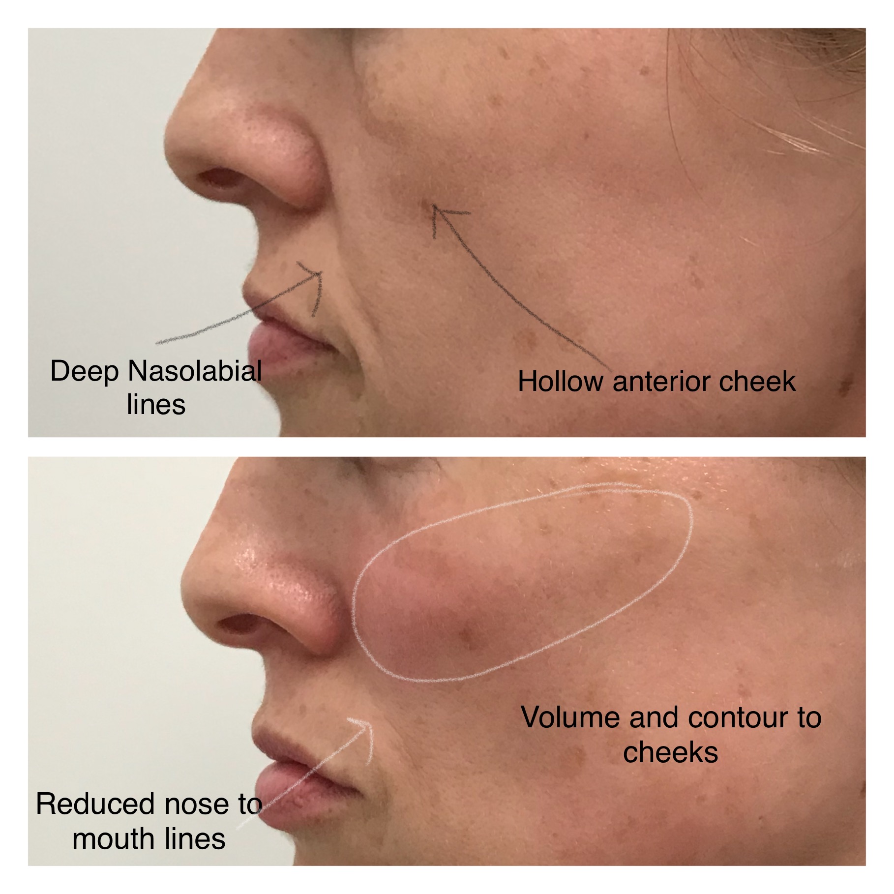 Cheek fillers
