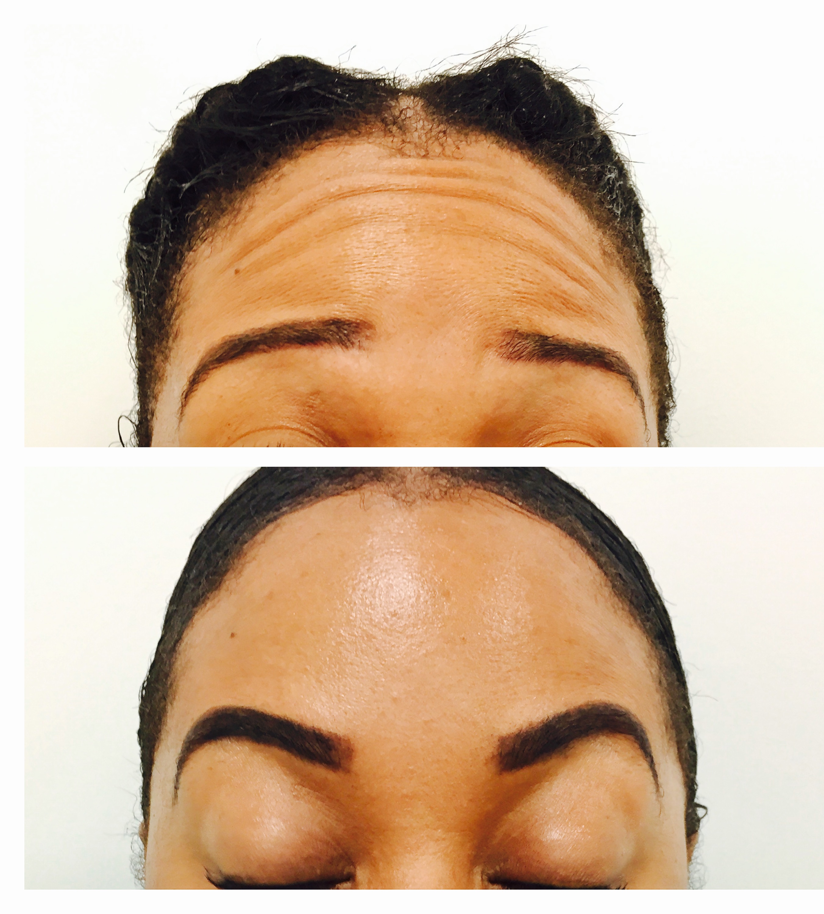 Brow lift with toxin
