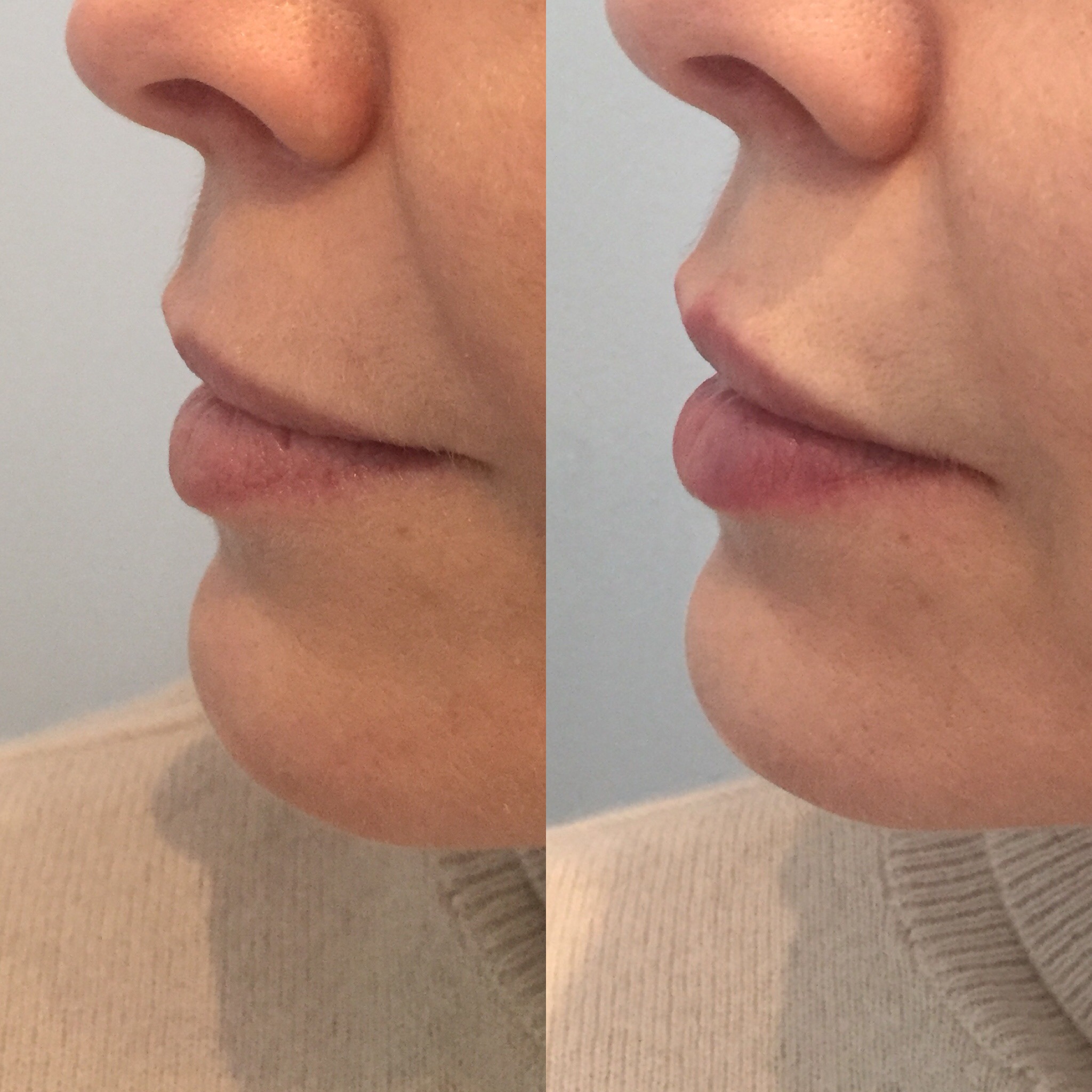 Subtle enhancement to lips