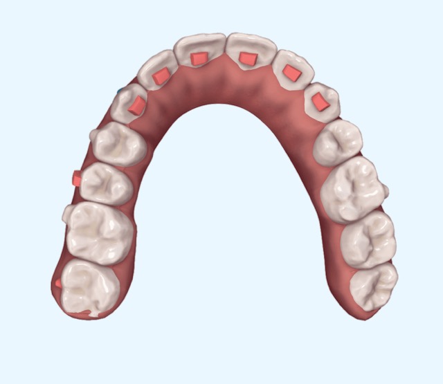 Invisalign Attachments: Das solltest du über sie wissen