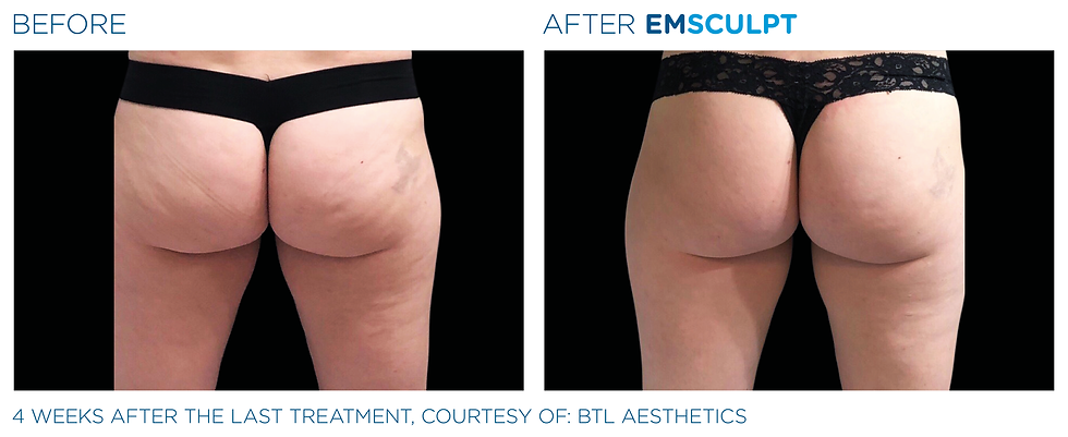 BTL EMSCULPT neo 緊實臀部肌肉效果圖