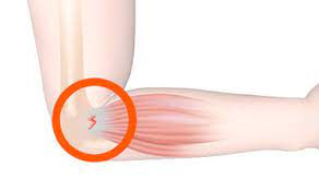 Is Your Elbow Pain a Sign of Vitamin Deficiency?
