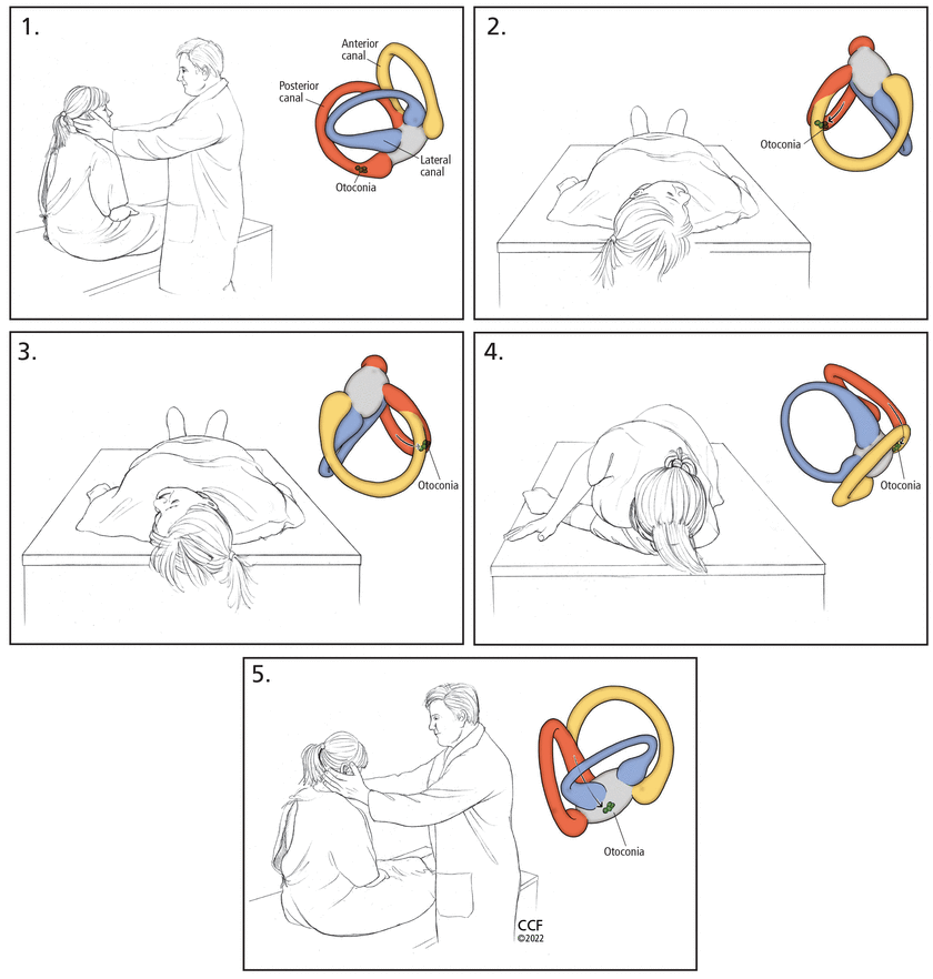 Epley Maneuver for dizziness Treatment
