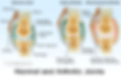 Reducing Rheumatoid Arthritis Pain with Anti-Inflammatory Diets