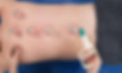 Cupping: What You Need to Know for a Pain-Free Life