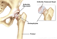 Osteoarthritis In The Hip - How Chiropractic Can Help