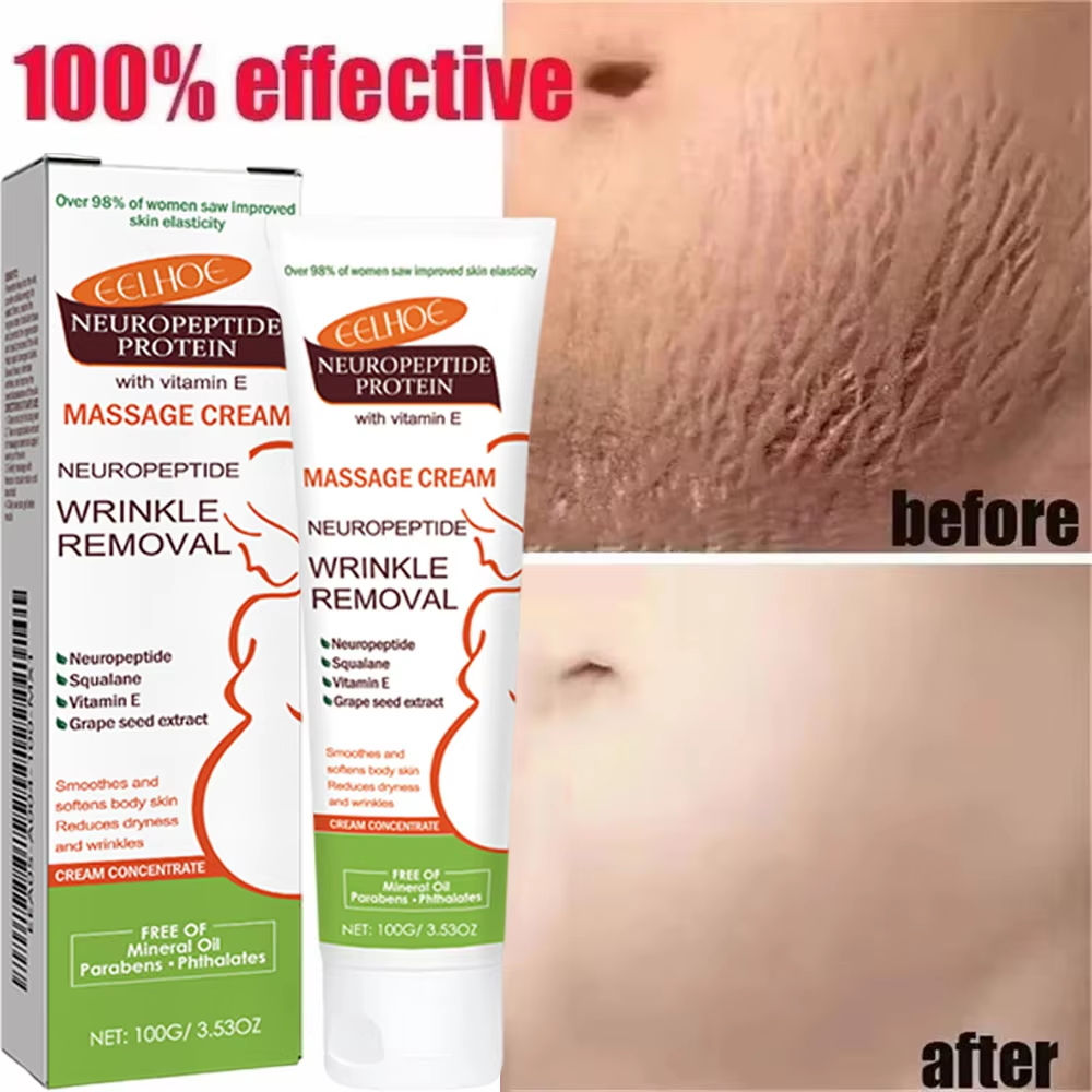 100g Stretch Marks Permanent Removal Cream Maternity Pregnant Women Pregnancy An