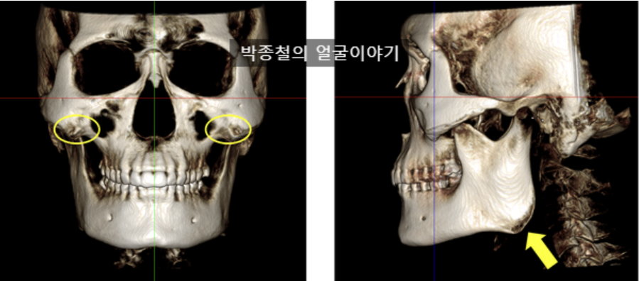남자사각턱수술 전 정면 골격 CT, 광대 결절과 사각턱 발달 확인
