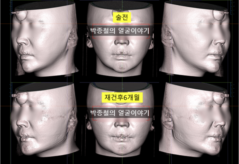 수술 전과 재건 6개월 후의 연조직 변화 비교