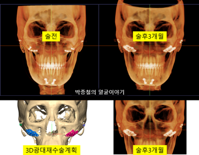 3D 광대 재수술 술후 CT 평가