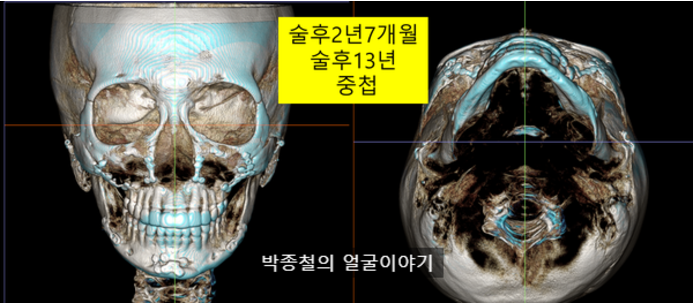 비대칭양악수술 후 장기적인 변화 (1년, 2년 7개월, 13년)