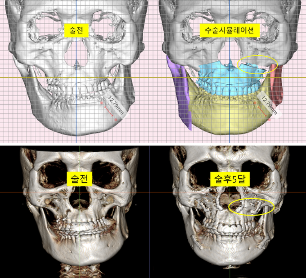 이미지 설명: 수술 후 5개월 차 CT에서, 수술 계획 시 예상되었던 상악 좌측 골 결손 부위(노란 타원)가 새로운 뼈로 단단하게 연결된 것이 관찰됩니다.