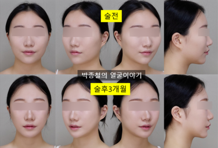 무턱 및 비대칭 개선을 위한 턱끝전진술(앞턱전진술) 증례 분석: 자가골 이식과 CT 분석을 통한 6개월 경과 보고